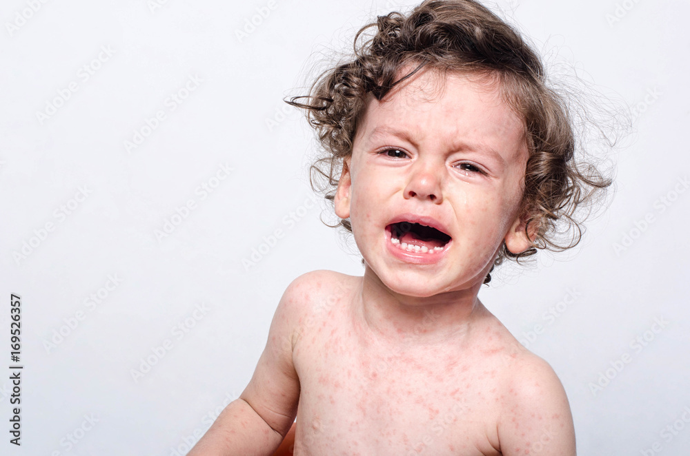 Portrait of a cute sick baby boy crying. Adorable upset child with spots on his face and body form illness, mosquito bites, roseola, rubella, measles. - obrazy, fototapety, plakaty 