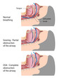 Snoring and OSA - Obstructive sleep apnea