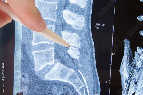 Cuadros en Lienzo Photo MRI lumbosacral spine pathology
