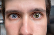© vchalup - Young man with heterochromia - two different colored eyes. Contact lenses.