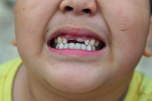 View Of An  Asian Boy With Broken Teeth