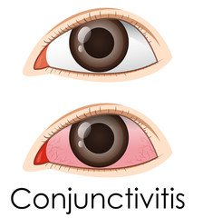 Sticker - Conjunctivitis in human eyes