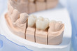 Detailaufnahme eines Prothesensattels mit Zahnersatz im Zahnlabor