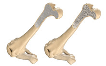 Human Thigh Bone - Normal And With Osteoporosis. 3D Illustration