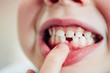 © sally anscombe/Stocksy - Child with first tooth missing