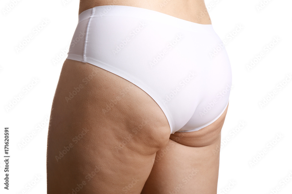 Woman with cellulite problem on white background