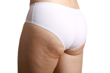 Sticker - Woman with cellulite problem on white background