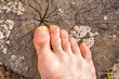 Toes of male foot, infected with a nail fungus on a gray cracked stump covered with white mold fungi.