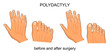 polydactyly before and after surgery