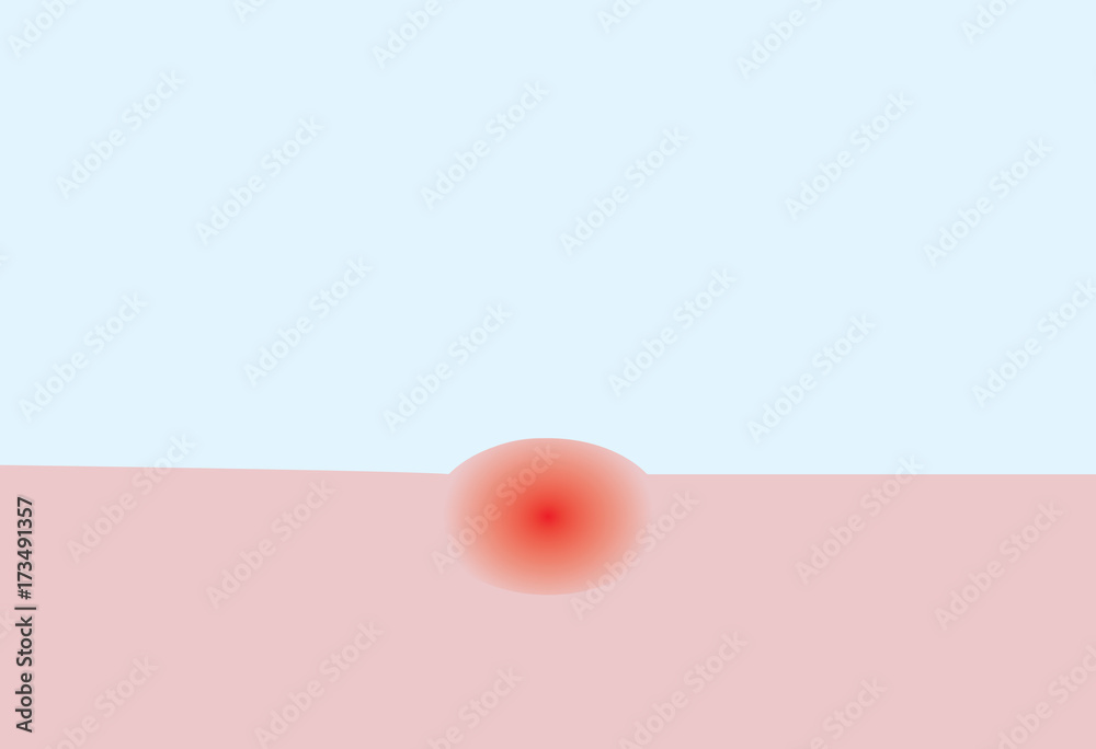 Red Bumpy Rash Graphics vector of allegic itchy red spot bump on the skin Stock Vector | Adobe ...