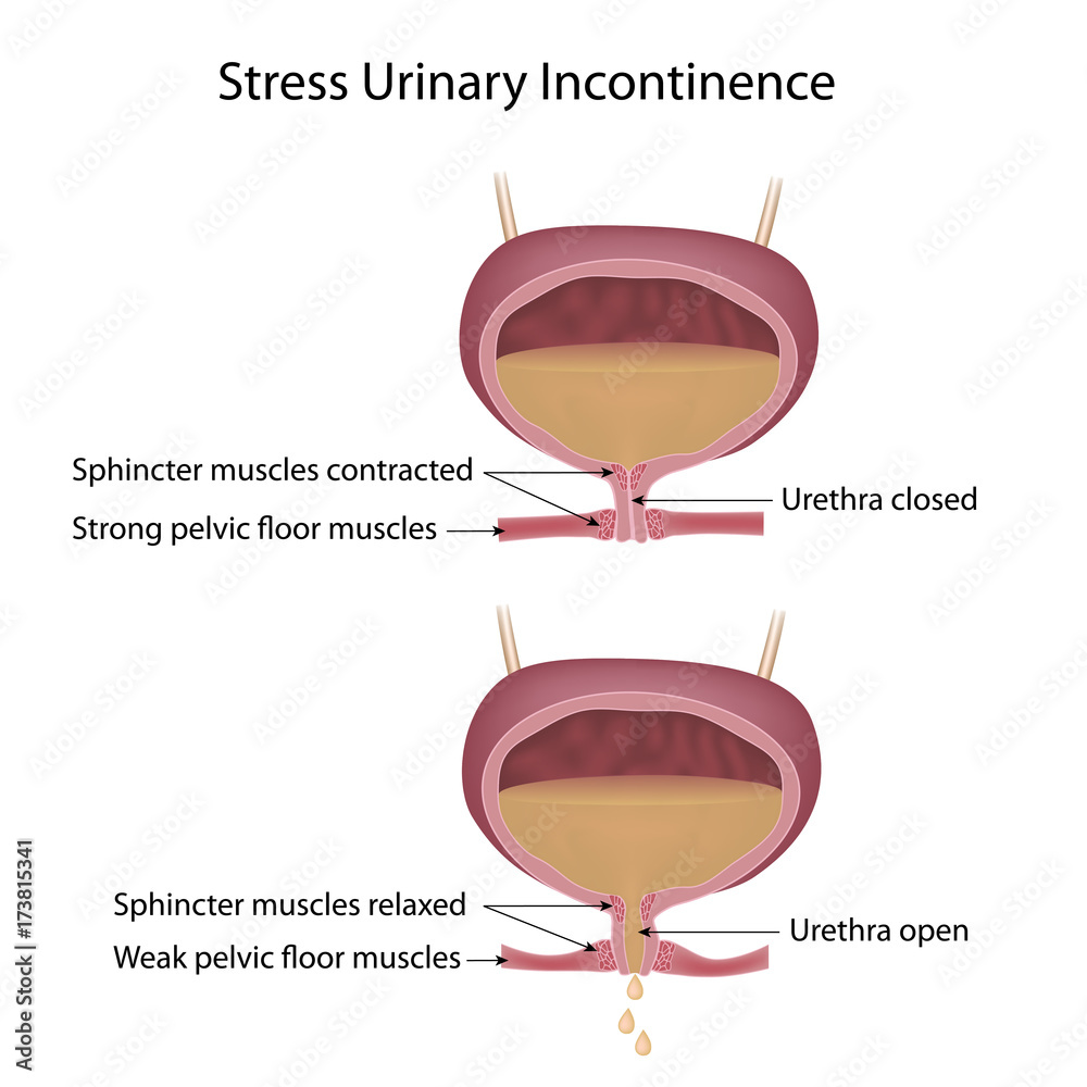 Stress urinary incontinence in women, labeled Stock Illustration ...