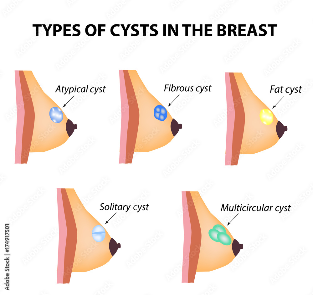 Types of cysts in the breast. Atypical, Fibrous, Fatty cyst, Solid cyst ...