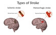 Stoke types poster, banner. Hemorrhagic, ischemic. Vector medical illustration. white background, anatomy image of damaged human brain, blocked and ruptured blood vessels.