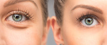 Woman Eye Bags Before And After Cosmetic Treatment