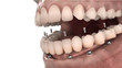 © lightmachine - Dental anatomy - Lower jaw implant overdenture