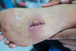 closeup  infection wound in the foot of patients . 