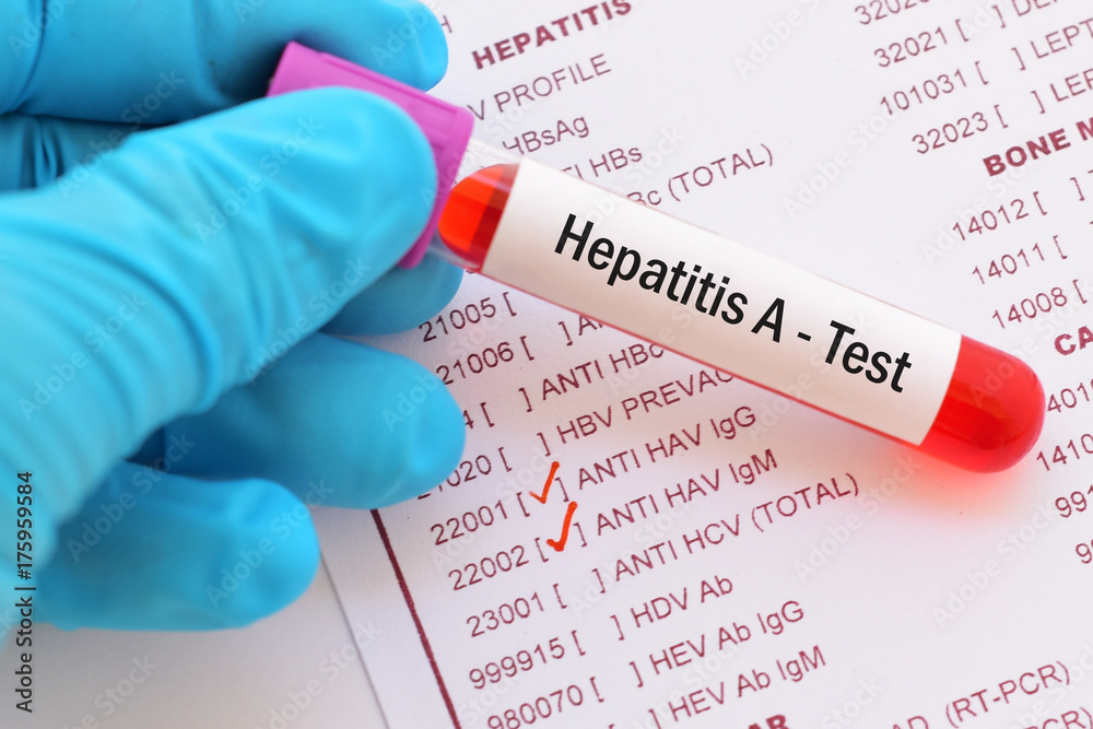 Blood sample with requisition form for hepatitis A virus (HAV) test
 - obrazy, fototapety, plakaty 