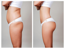 Female Body Before And After Treatment. Plastic Surgery.