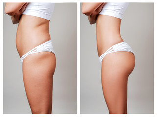 female body before and after treatment. plastic surgery.