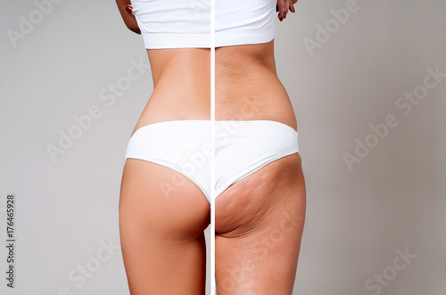 Fotografie, Tablou Female body before and after treatment. Plastic surgery.
