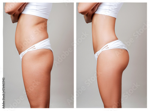 Fotomural Female body before and after treatment. Plastic surgery.