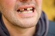 problems with teeth men of the European race