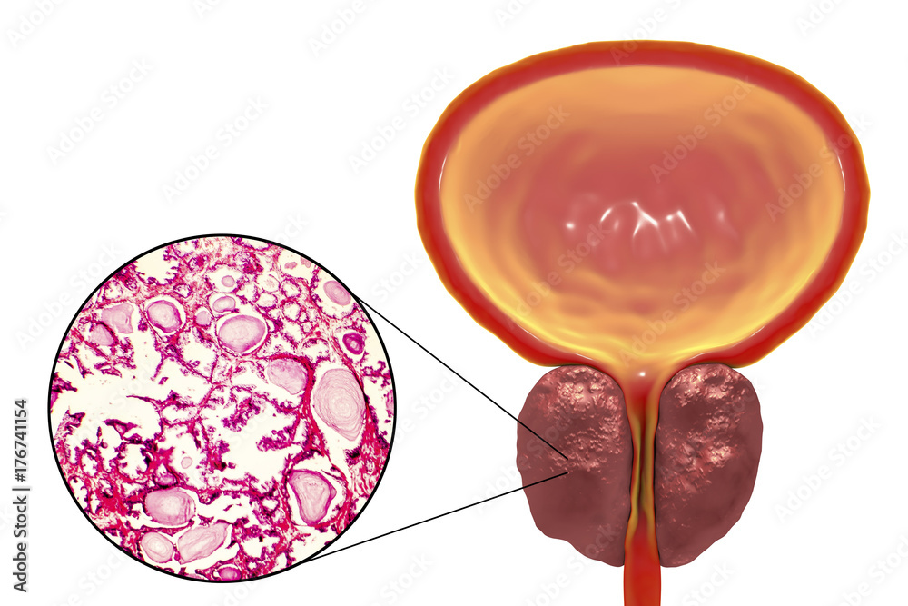 Prostatic Cell Benign prostatic hyperplasia, 3D illustration showing enlarged prostate ...