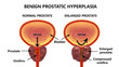 © Dr_Microbe - Benign prostatic hyperplasia, 3D illustration showing normal and enlarged prostate gland