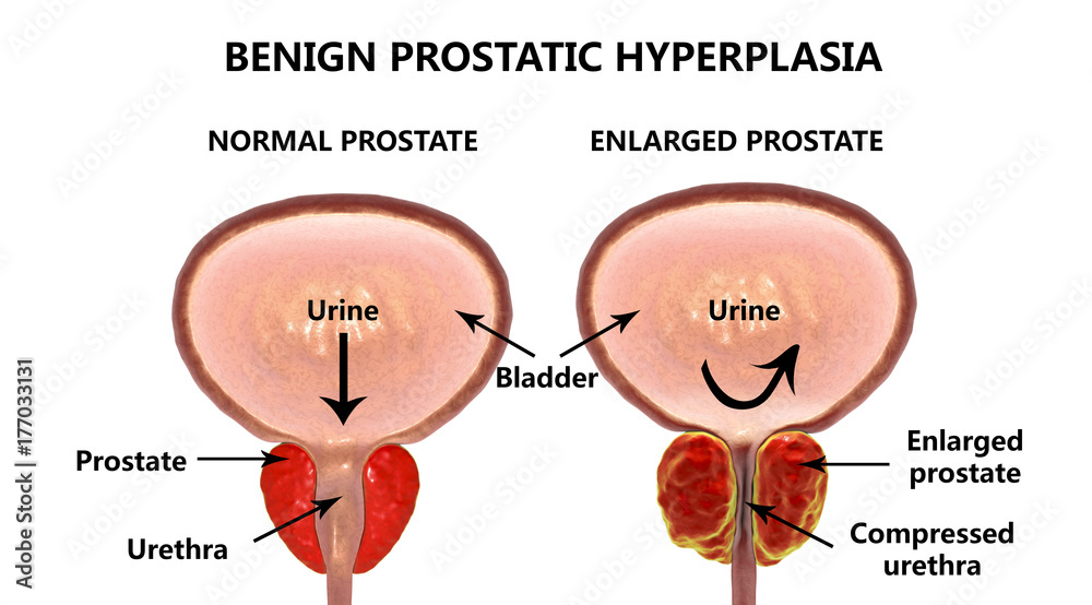Prostate Nhs Benign prostatic hyperplasia, 3D illustration showing normal and ...