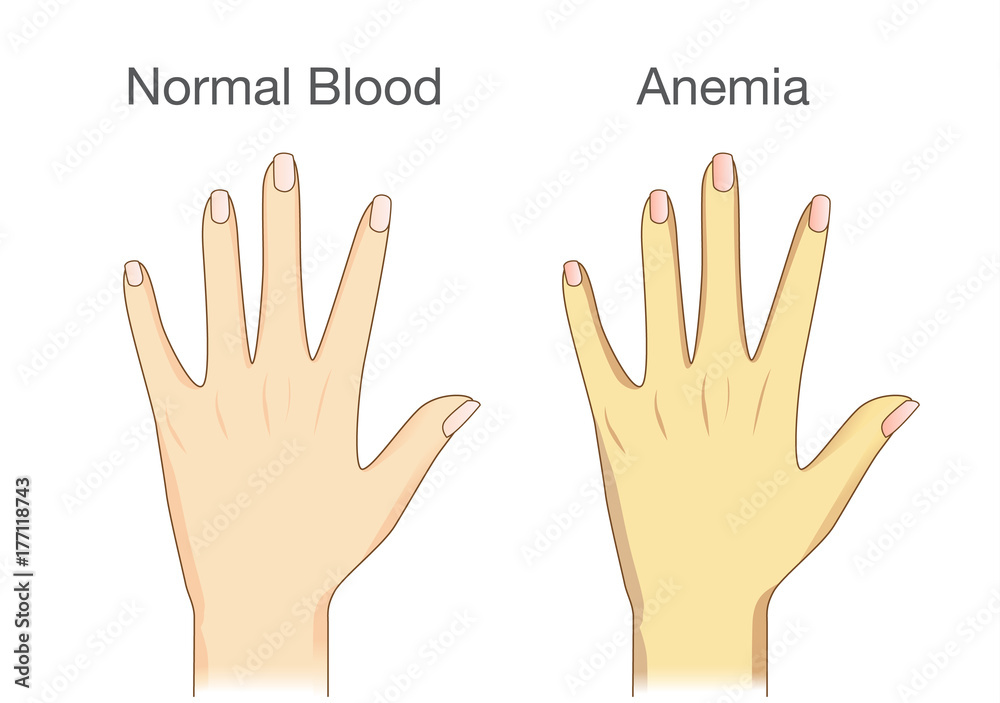 The effect of Anemia on skin blood flow in human. Compared color of ...