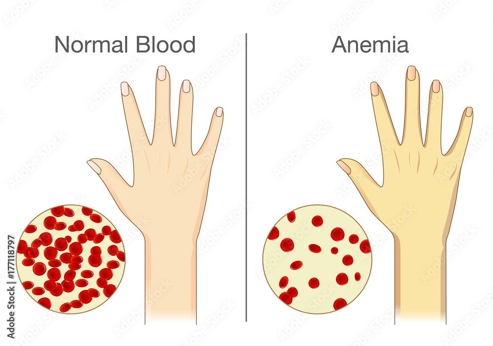 The effect of Anemia on skin blood flow in human. Compared color of ...