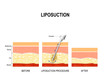 liposuction procedure. Before and after