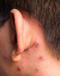 © CK Bangkok Photo. - Chicken pox rash