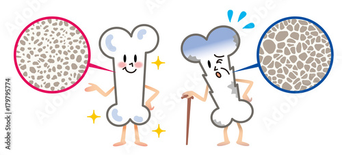 骨 骨密度 骨粗しょう症 イラスト Stock Illustration Adobe Stock 骨 骨密度 骨粗しょう症 イラスト Stock Illustration Adobe Stock