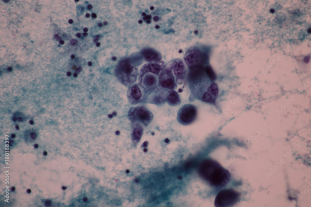 View in microscopic of adenocarcinoma cell in pleural effusion cytology ...