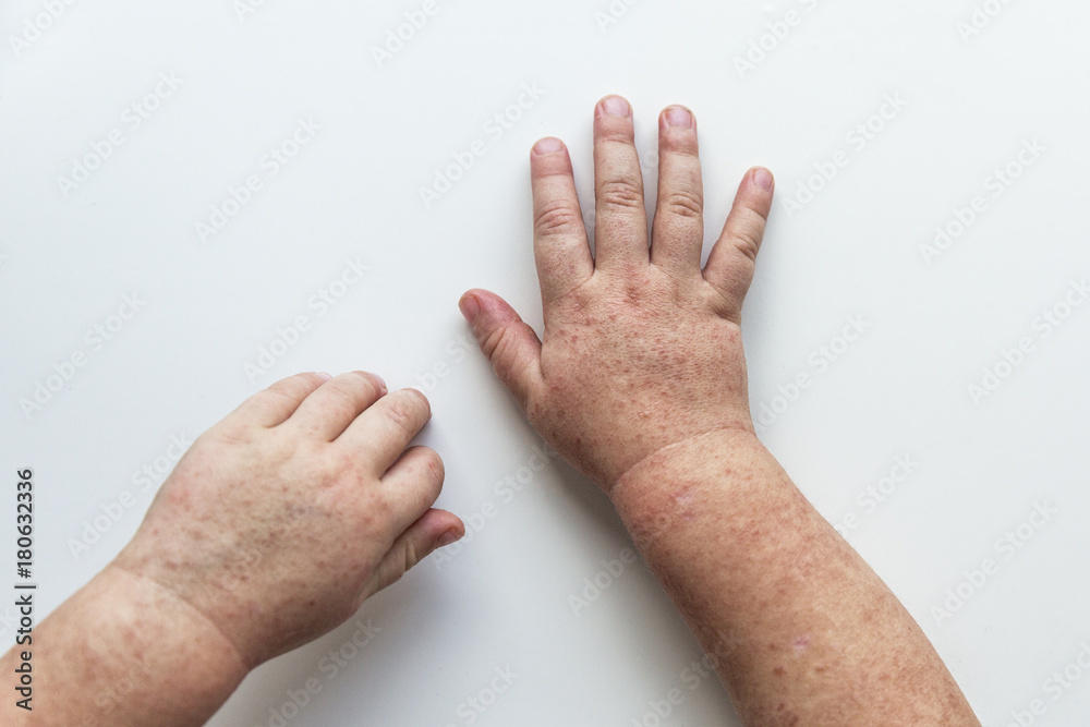 Scarlet Fever Rash On Hands