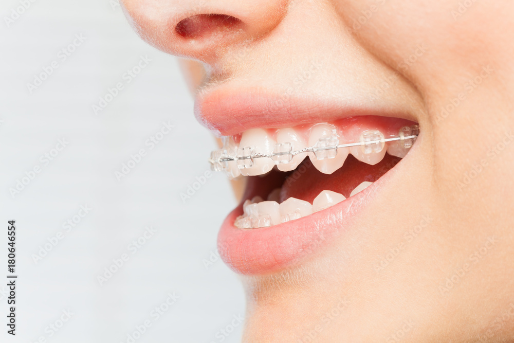Woman's smile with clear dental braces on teeth Stock Photo | Adobe Stock