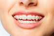 © Sergey Novikov - Healthy smile woman with clear brackets
