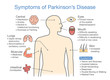 Parkinson's disease symptoms and signs. Illustration about medical diagram.