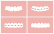 Vector image of the stages of orthodontic treatment (braces on teeth)