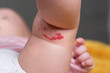 Capillary hemangioma red birthmark on the babys leg