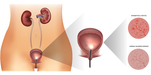 Poster - Urinary bladder examination, healthy lining and unhealthy inflamed lining with cystitis on a white background. Female silhouette and detailed urinary system.