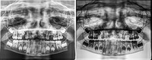 Panoramic Dental Xray Of A Child, Deciduous - Milk Teeth Growing From The Jaw Bone (quality Of Xray Images Is Always A Compromise Between Patient Safety Limits And Sufficient Dose For Diagnosis)