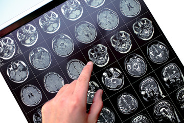 Wall Mural - Finger pointing on the affected area in the patient's head on the MRI image