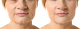 Fototapeta  - Mature woman before and after biorevitalization procedure on white background