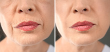 Senior Woman Before And After Biorevitalization Procedure, Closeup