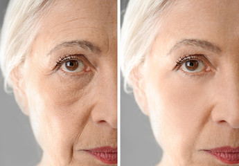 Wall Mural - Senior woman before and after biorevitalization procedure, closeup