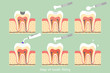 step of caries to tooth amalgam filling with dental tools
