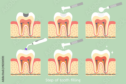 Fotografija step of caries to tooth amalgam filling with dental tools