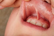 the bridle of the upper lip in the child close up